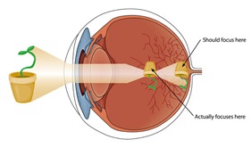 myopia23