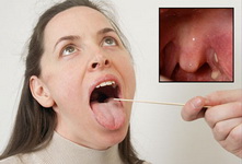 tonsil_stones_m.jpg