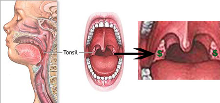 tonsilgold.jpg